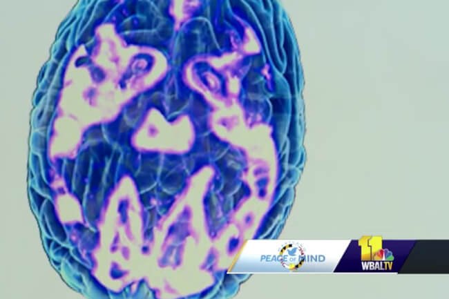 TMS treats depression by waking up brain cells using magnetic pulse